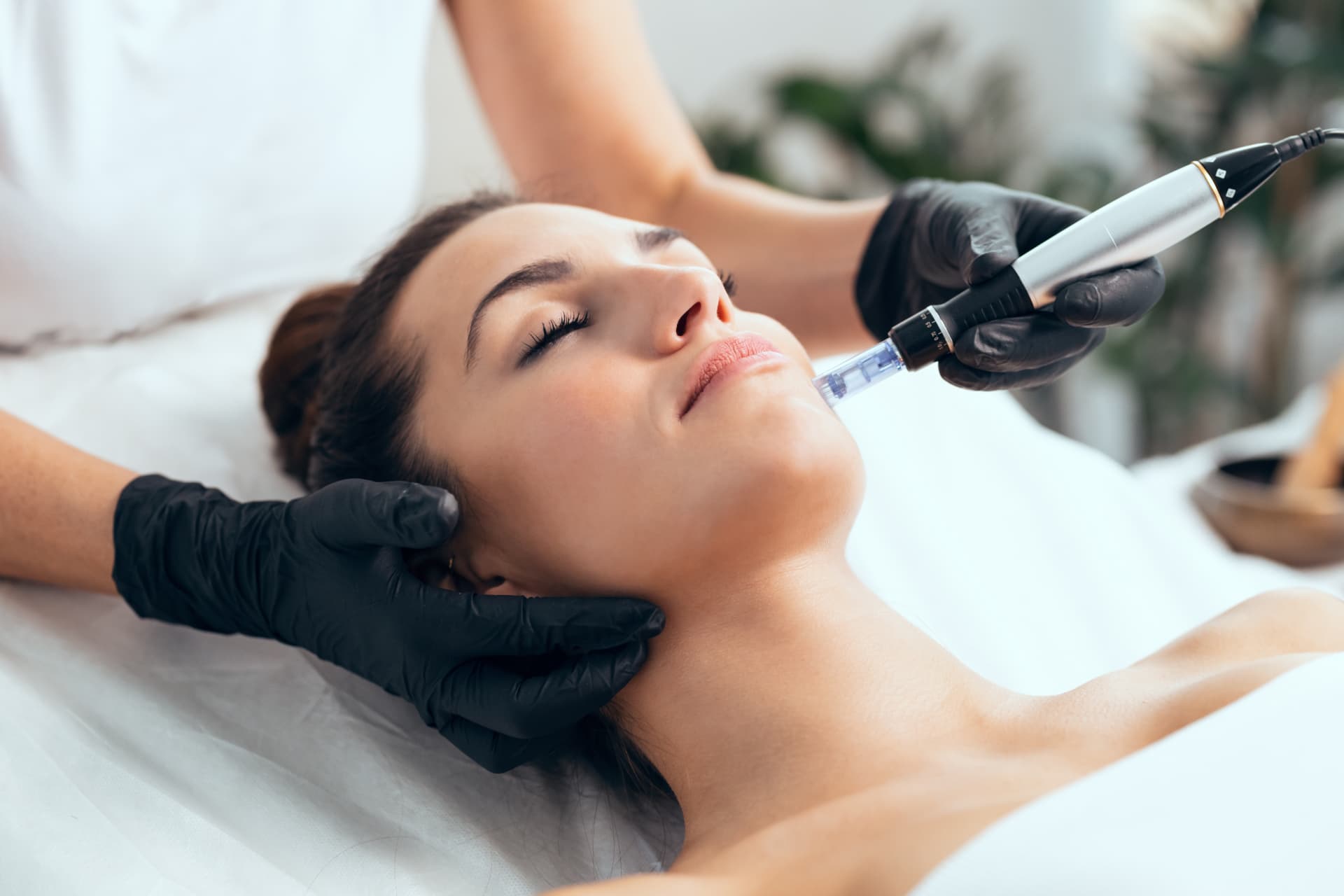 Microneedling mit einem Pen an der Kinnpartie